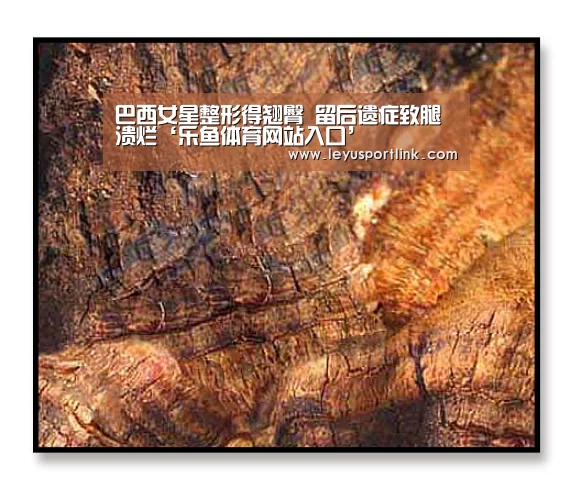 巴西女星整形得翘臀  留后遗症致腿溃烂‘乐鱼体育网站入口’(图2)